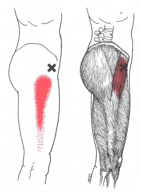 Tensor Fasciae Latae | The Trigger Point & Referred Pain Guide